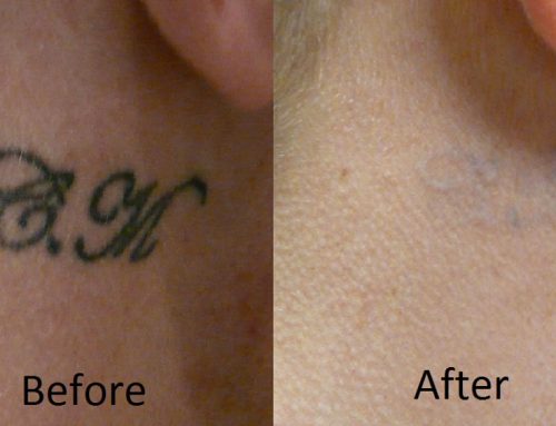 Tattoo Laser Removal Information